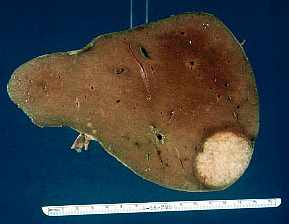 Liver cancer - liver adenocarcinoma (white)