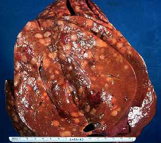 Hodgkins Cancer - nodular hodgkins- metast to liver cancer