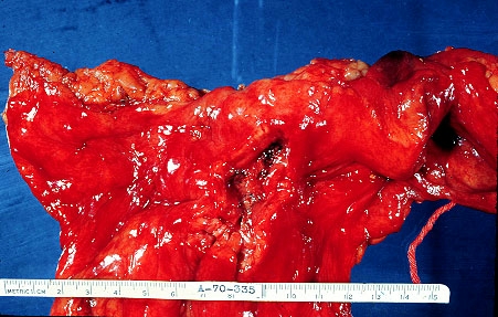 Colon Cancer (colon carcinoma - colorectal cancer)