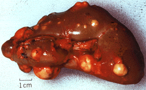 kidney cancer, papillary renal cancer, renal carcinoma