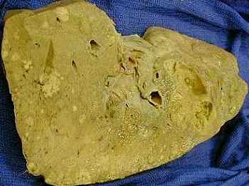 Liver cancer - primary liver cancer tumor with others (white)