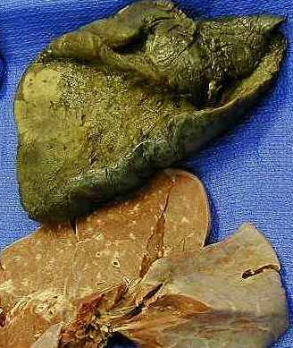 x rays of lung cancer. Lung Cancer - adenocarcinoma