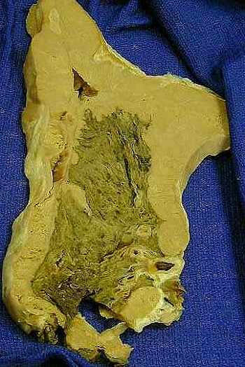Lung cancer - light area cancer of pleura from asbestosis