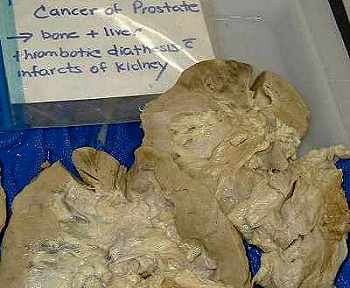 Prostate cancer with bone cancer, kidney cancer 